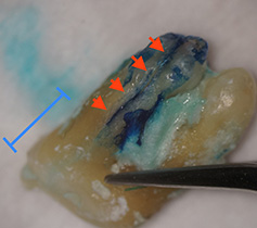 抜歯後（赤↓がひびです）。青い部分が歯ぐきより上の歯の頭の部分です。歯の根っこのひび割れの場合は、ひびの部分ははぐきにおおわれているので、ぱっと見ただけではほとんどわかりません。治療を進めて行かないと、検出が難しいのです。