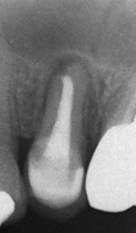 術前のレントゲン写真。太い根管充填と土台が入っています。深い歯周ポケットはありましたが、このレントゲンだけで根のひびは確定診断できません。