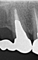 太く長い金属のポストが入っている状態。歯が薄くなってるためひび割れのリスクが高いです。