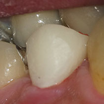 根管治療前に行う治療重要性7　仮歯装着