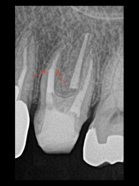 根管治療終了、赤い矢印部が削って歯が薄くなっているところ。