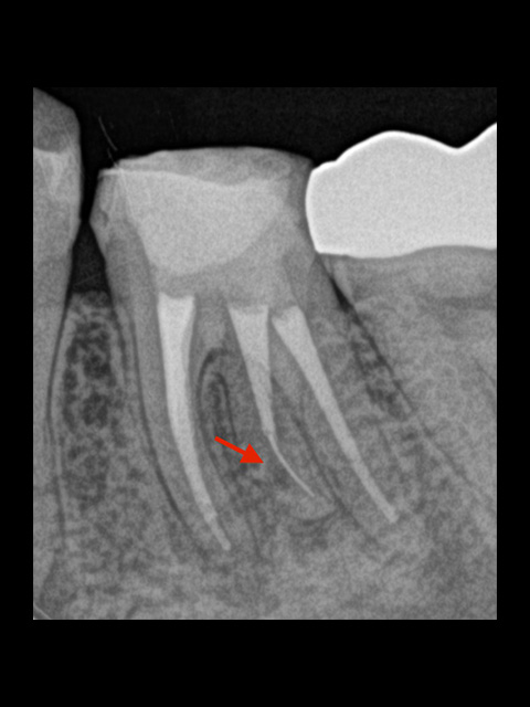 根管治療終了。根管のカーブしたところに食い込むように折れていますので、歯が薄くなるリスクをご説明し、外さない方向で治療を行いました。