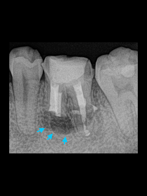 歯根端切除術後