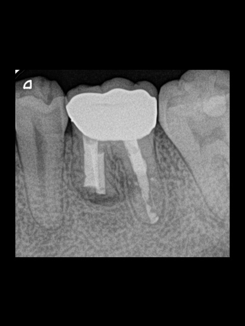 歯根端切除後9ヶ月経過。手術で切った部位には健康な骨が回復して黒い影がなくなっています。症状も違和感も現在はありません。