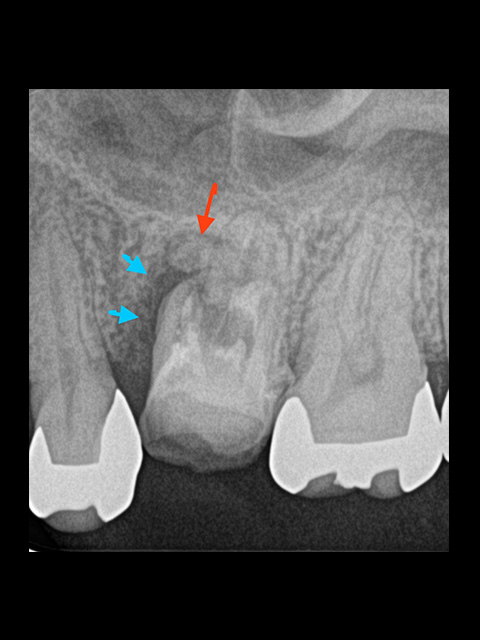 青→部は根の表面に沿って骨がなくなっています。歯周ポケットも深く根のヒビを大きく疑います。 赤→部は根の先端が割れているのか、白い塊状の不透過像がみられます。 ヒビを疑いましたので、予後が悪いことをご説明し、抜歯をお勧めしましたが延命的な治療でも良いので今は抜きたくない、ということから治療をスタートしました。