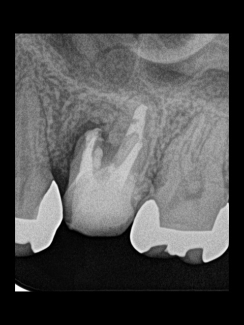 根管治療後3ヶ月経過。黒い影はだいぶ薄くなり治癒傾向がみられますが、症状がまだあり、歯根端切除術へ。