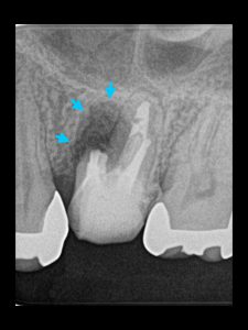 歯根端切除術後。根先端は砕けていて、折れた破片を取り除きました。 切断した断面を観察すると、やはりヒビがあります。取れる範囲で取り除きMTAセメントで修復。