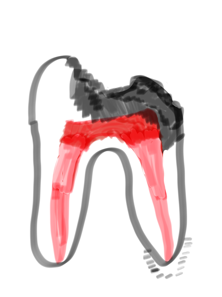 歯髄炎から歯髄壊死に至るまでの期間は診断が難しい