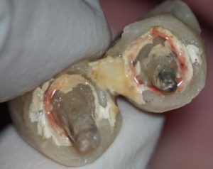 差し込みの仮歯の裏側の汚れ