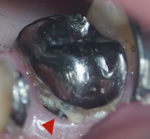 被せた歯の下から虫歯になると根管治療が失敗する