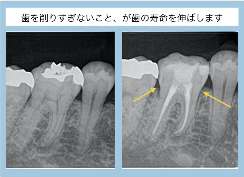 歯を削りすぎない根管治療専門医の治療