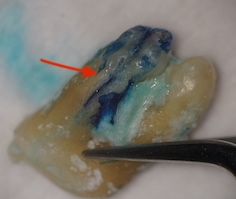 歯根破折の歯