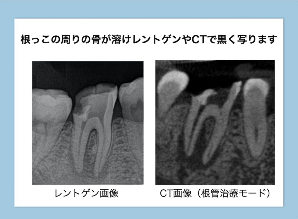 根尖性歯周炎のレントゲンとCT画像