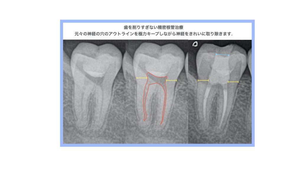 根管治療専門医の歯を弱めない削らない治療 