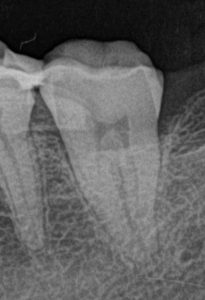 歯冠のクラック治療
