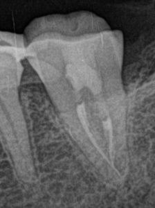 歯冠のクラック歯治療、根管治療の場合