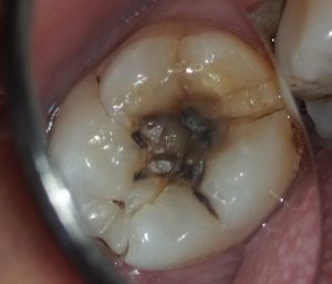 歯冠のひび　スプリットトゥース