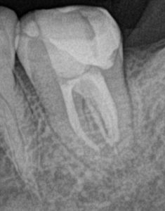 予後不良の歯冠のひび、クラック歯