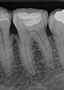 歯を極力削らない、失敗しない当院の初回根管治療の１例