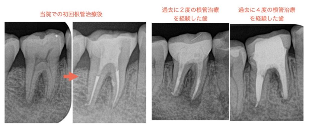 繰り返す根管治療、行き着く果ては歯根破折で抜歯