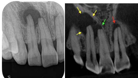 根尖孔外感染のため根管治療のみでは治らなかったケース