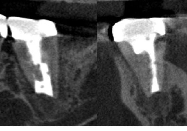 意図的再植術、術後一年、治癒確認