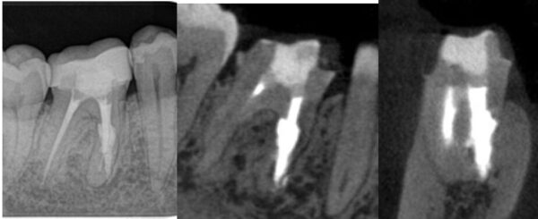 内部吸収の治療後2年経過
