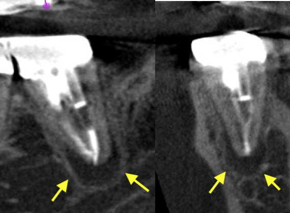 意図的再植術　術前CBCT