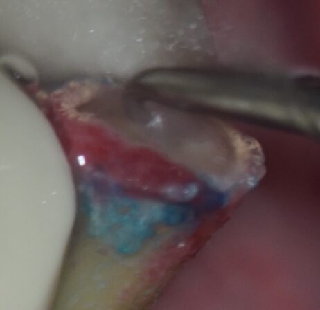 意図的再植術、術式３