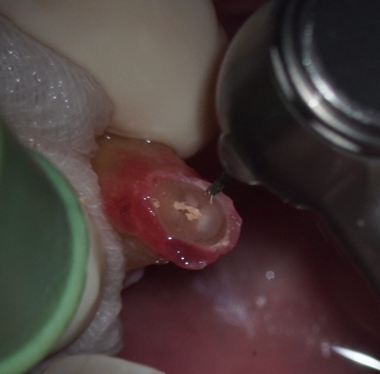 意図的再植術、術式２