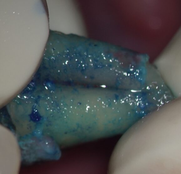 意図的再植術、術式４